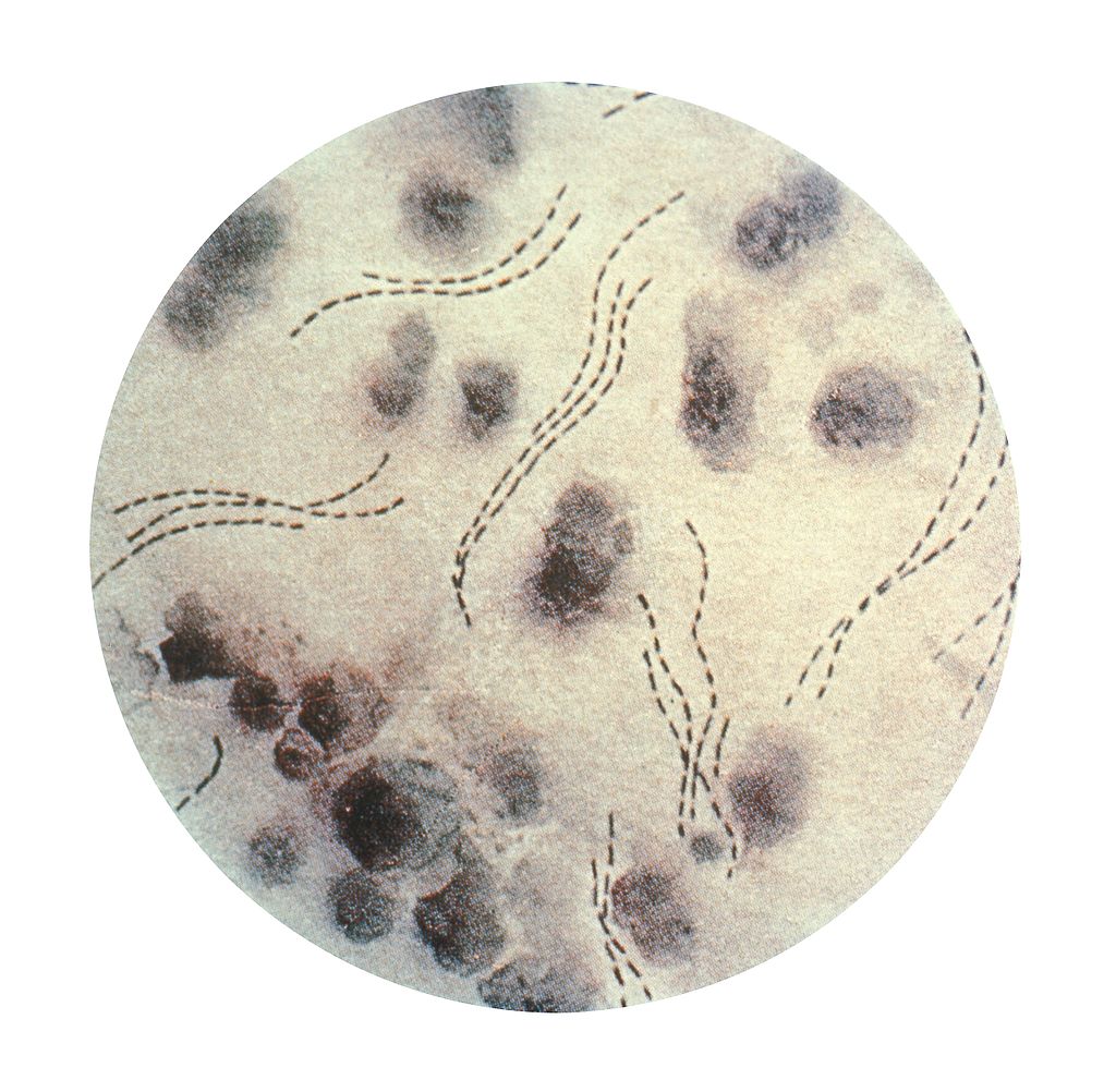 Haemophilus influenzae b-Infektion