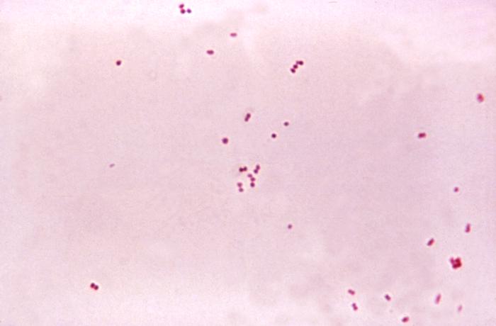 Hirnhautentzündung (Meningitis)